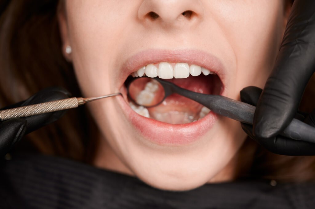 teeth whitening in oxnard