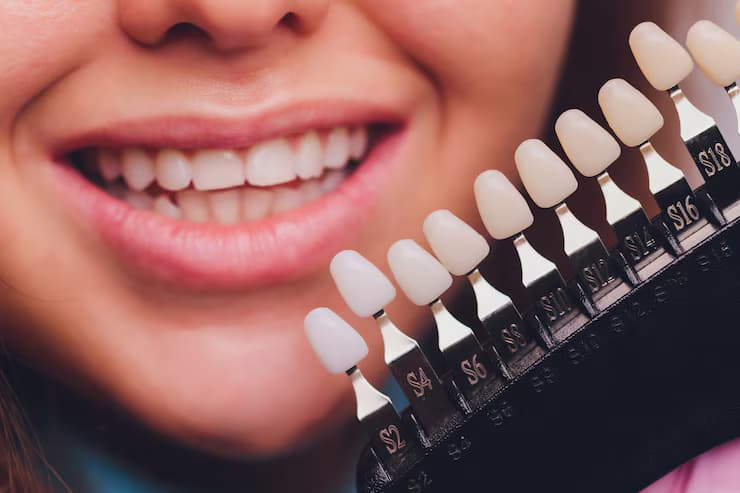 porcelain veneers in oxnard