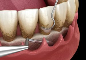 dental scaling
