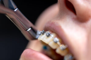 Traditional Metal Braces