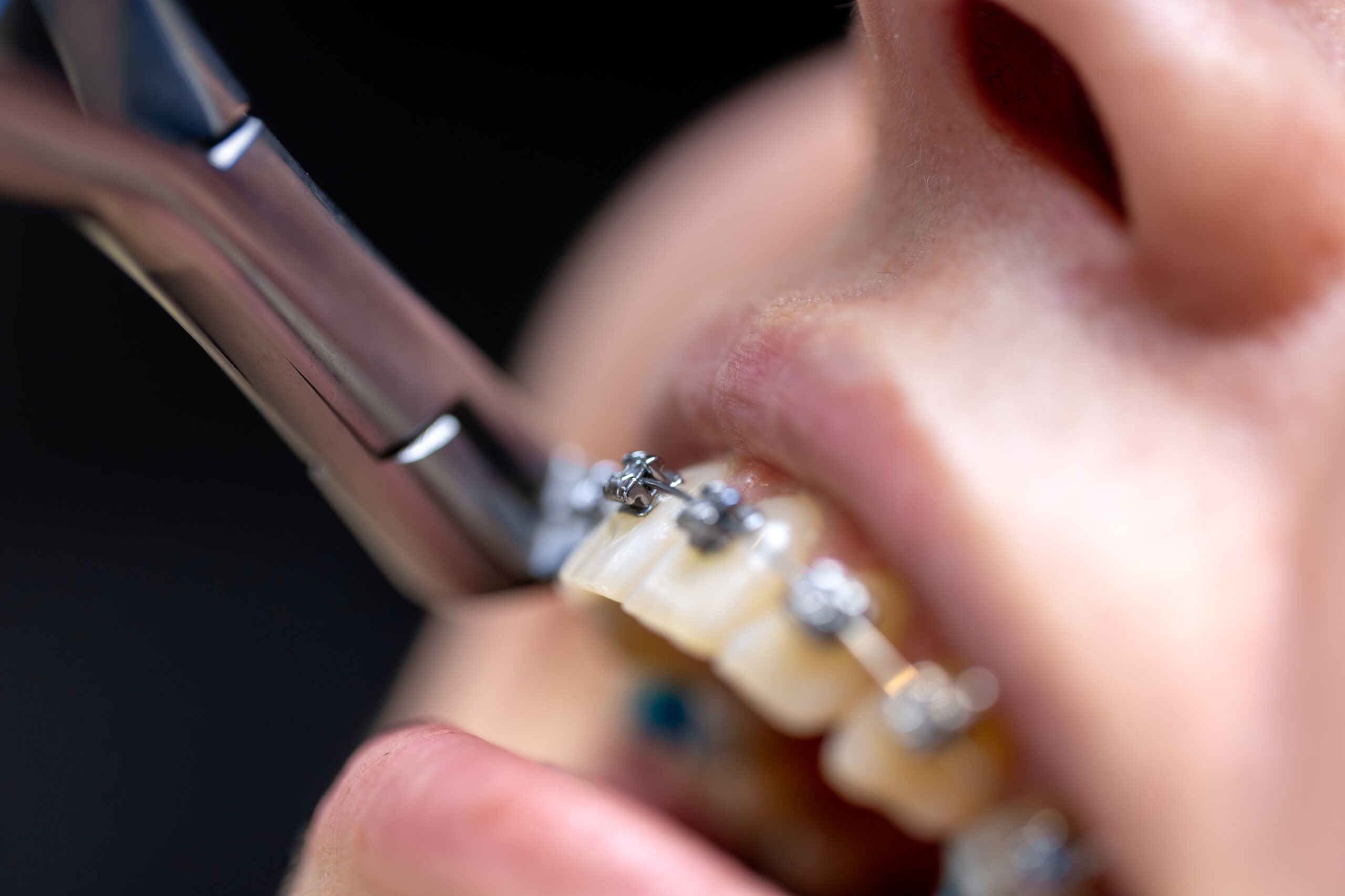 Traditional Metal Braces