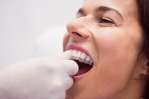 mouth guard