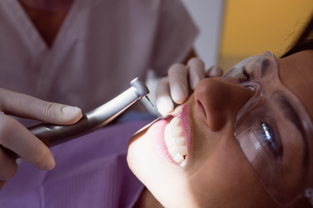 Resin Veneers