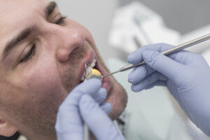 Mercury in Dental Fillings