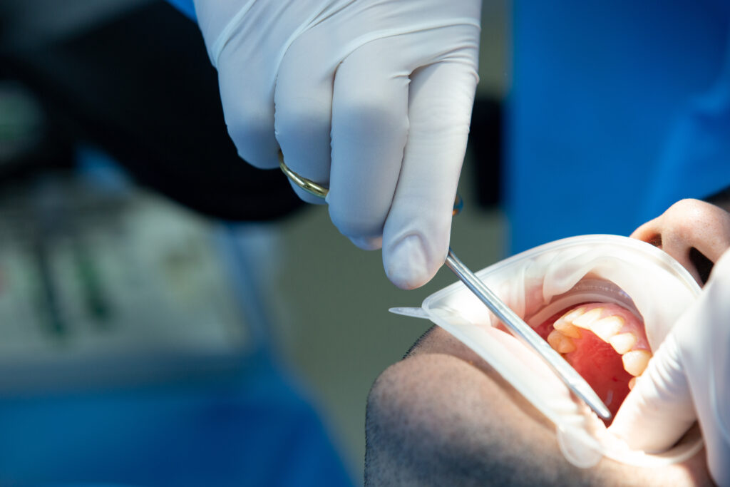 tooth extraction