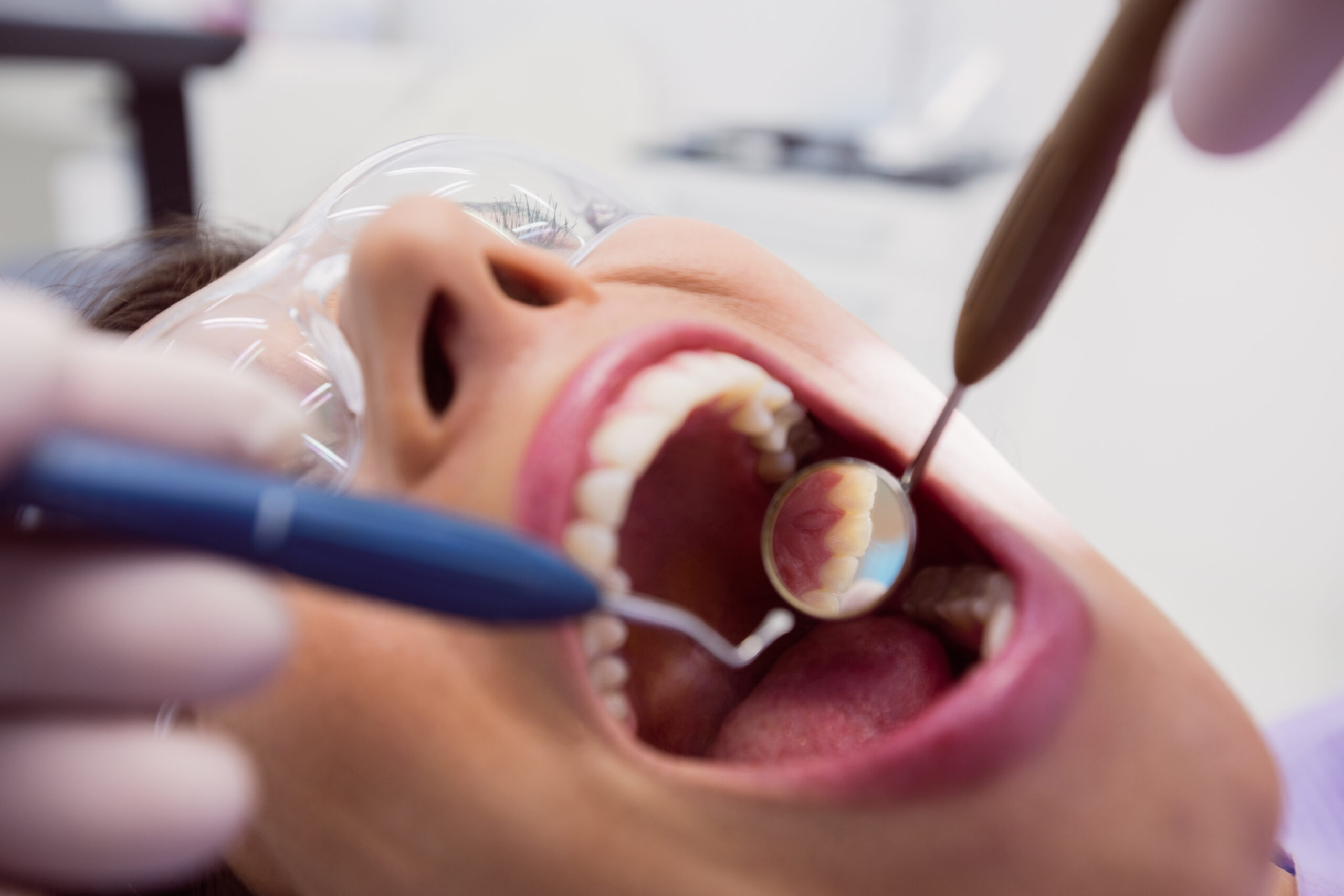 Fluoride Treatments