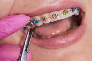 traditional metal braces