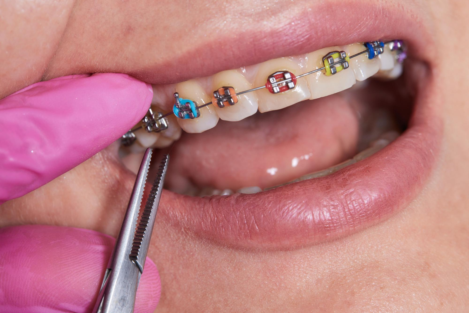 traditional metal braces